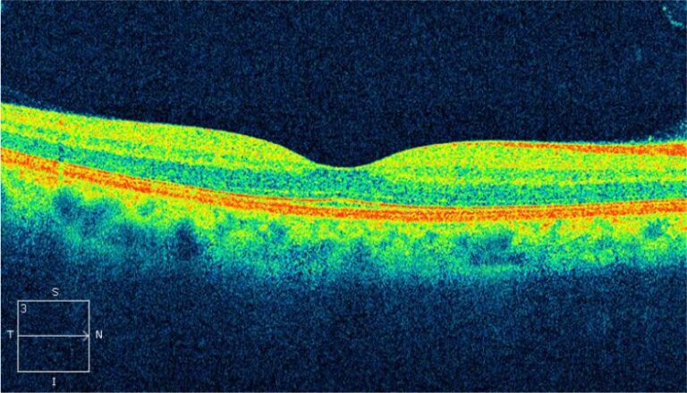 oct_de_macula