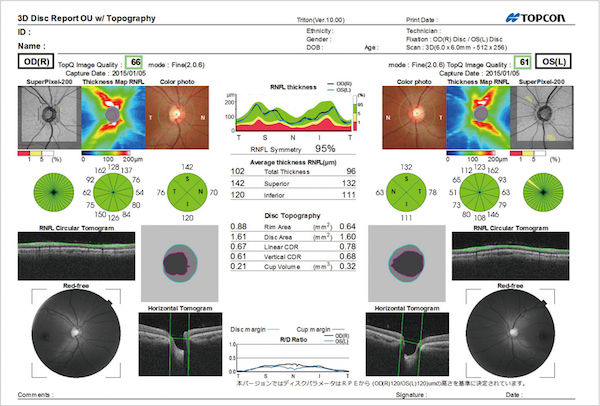 oct-glaucoma