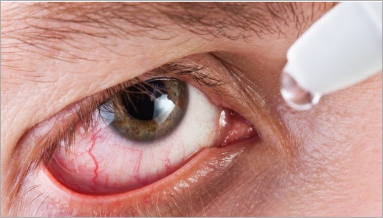Dica-sindrome-olho-seco (1)
